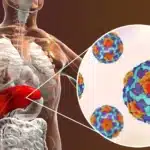 Hepatitis A