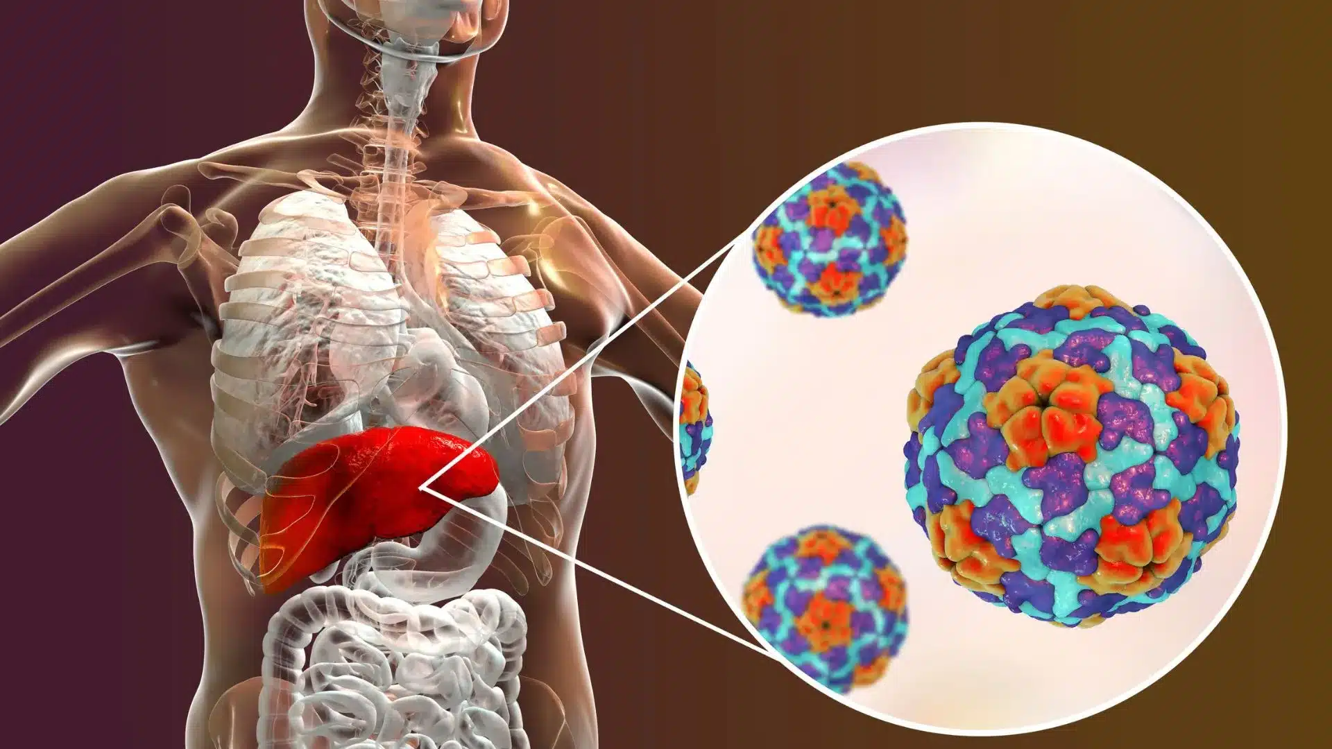 Hepatitis A