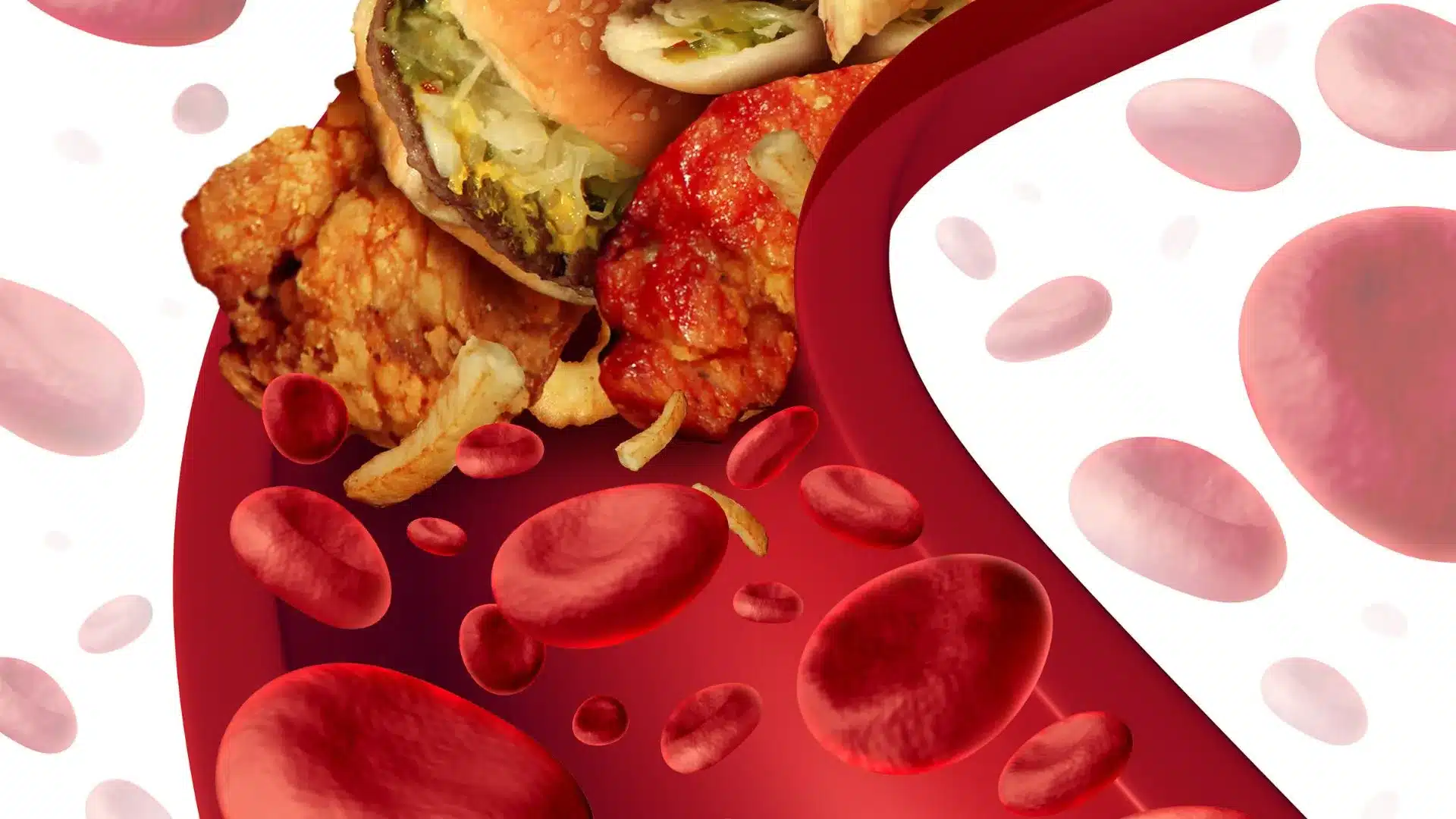 High cholesterol