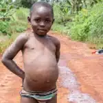 Kwashiorkor