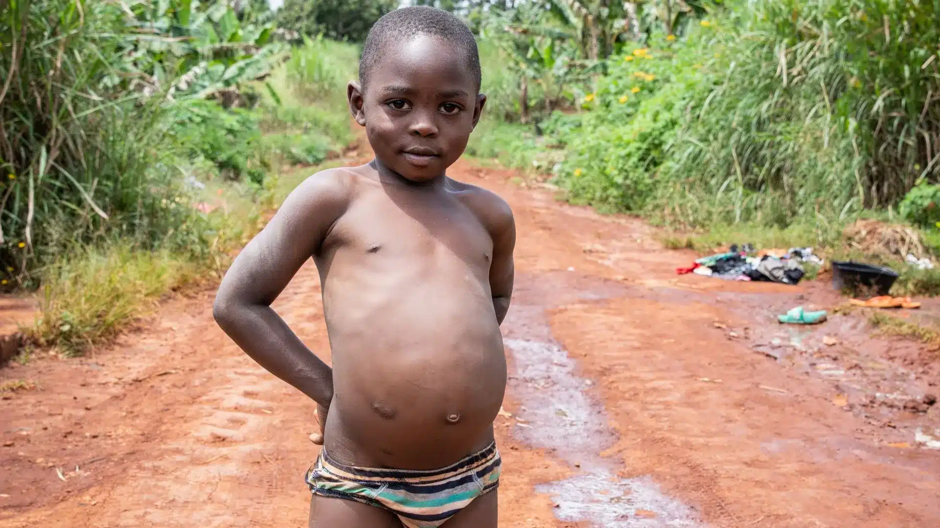 Kwashiorkor