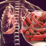 Tuberculosis