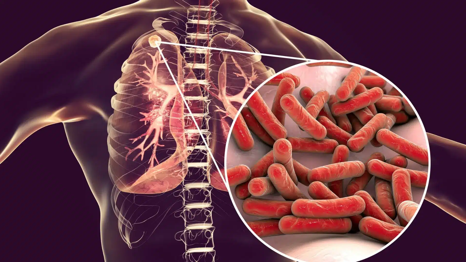 Tuberculosis