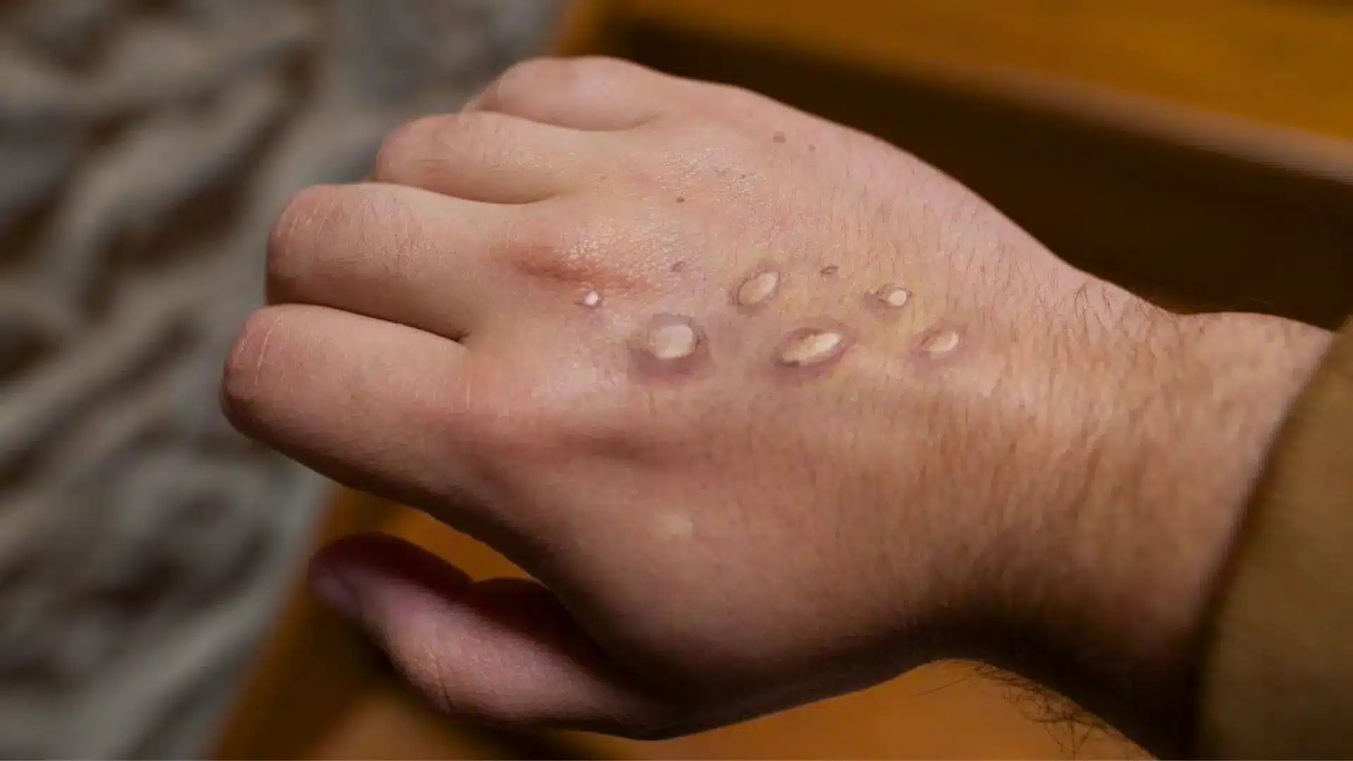 Mpox